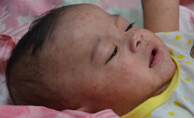 Measles immunisation campaign underway in Samoa